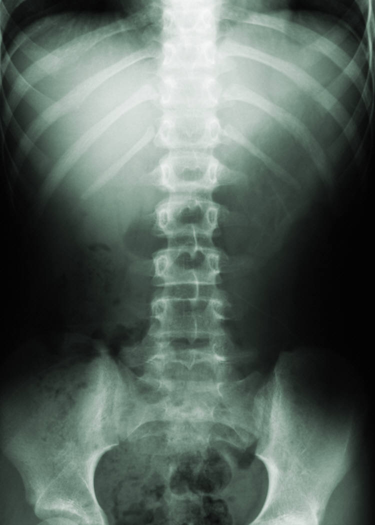 xray of spinal area
