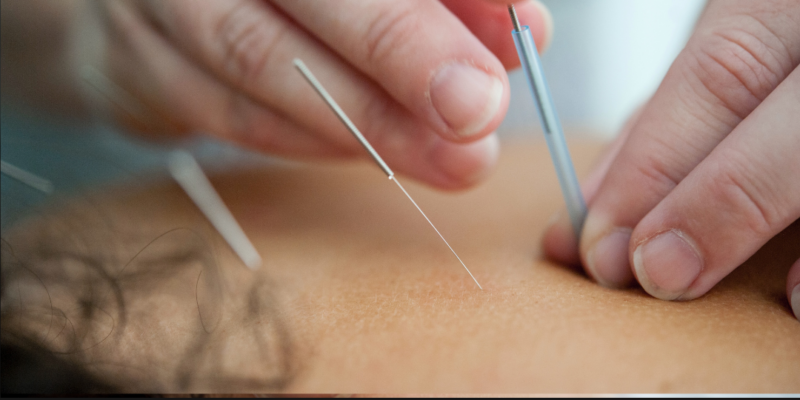 Acupuncture treatments at Hatch Chiropractic Parker Colorado